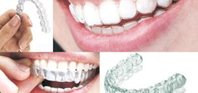 牙齒矯正提升顏值 另類整形不動刀